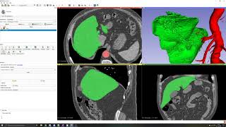 3D Slicer Tutorial 4 Smoothing Plugins [upl. by Esmaria]