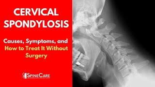 Spasmodic TorticollisCervical Dystonia Treatment Case 6 Part 1 Dr Demerjian [upl. by Myrtice877]