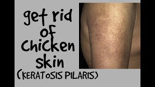 HOW TO GET RID OF CHICKEN SKIN KERATOSIS PILARIS DR DRAY [upl. by Clercq]