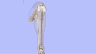 Intramedullary Nailing of the Tibia [upl. by Jeni]