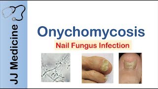 Onychomycosis  Nail Infection  Signs Symptoms Treatment [upl. by Ahsas]