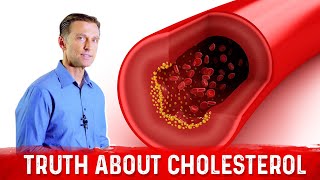 The Truth About Cholesterol – LDL Cholesterol amp HDL Cholesterol – DrBerg [upl. by Ecenahs]