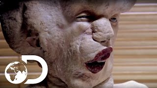 Joseph Merrick Medical Condition Explained [upl. by Annocahs]