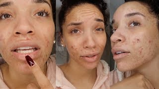 My Accutane Experience  First Week  Acne Update 3 [upl. by Peyter]