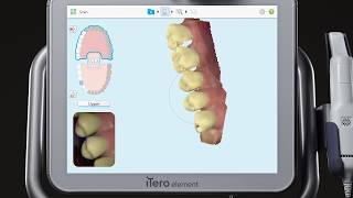 iTero® Scanner Tutorial Charting and Scanning for an Implant [upl. by Anisor]