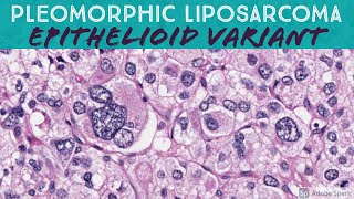 Pleomorphic Liposarcoma Epithelioid Variant [upl. by Cletis]