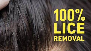 How to Treat Lice at Home [upl. by Pandolfi]