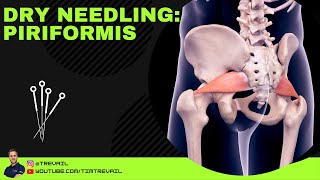 Dry Needling Piriformis [upl. by Annahael1]