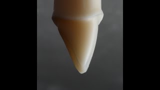 All Ceramic Crown Preparation for Emax and Zirconia [upl. by Bertold361]