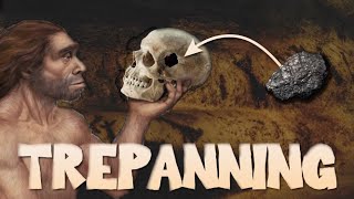 The History of Trepanning [upl. by Atinihs580]