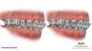 Different Types of Braces Metal Clear or Ceramic Hidden or Lingual [upl. by Iveson]