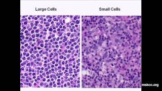 Signs and symptoms of lymphoma  Mayo Clinic [upl. by Cutcheon]