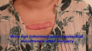 Chest Keloids  Mistakes to Avoid [upl. by Ralat224]