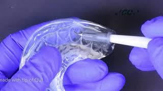 Injection moulding technique with GC Exaclear Gaenial Universal Injectable [upl. by Robinette]