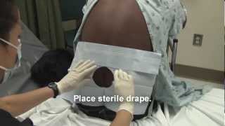 Adult Spinal Tap Procedure Video [upl. by Adrianne]