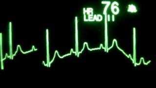 Sinus Rhythm with Respirations [upl. by Docila]