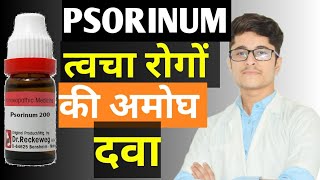 Psorinum 1M  Psorinum 200 Homoeopathic Medicine uses in Hindi [upl. by Loginov]