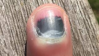 Fingernail Time Lapse 4 Month Recovery [upl. by Navonod170]