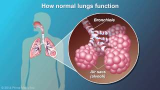 Understanding COPD [upl. by Taber]