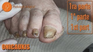 Onicauxis onychomycosis amp callosities Part 1 podologiaintegral [upl. by Chandra]