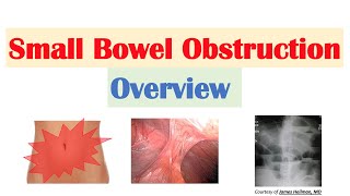 Intestinal Obstruction  Small Bowel Obstruction vs Large Bowel Obstruction [upl. by Cantu]