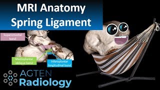 Spring Ligament Complex MRI Anatomy [upl. by Anesusa]