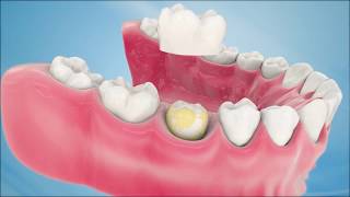 Dental Crown Procedure [upl. by Anihsat190]