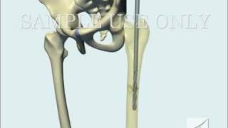 Femoral Fracture Fixation Surgery Intramedullary Nail [upl. by Wahl382]