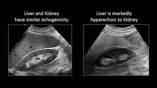 GI Imaging  Hepatic Steatosis and Cirrhosis [upl. by Etolas766]