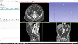 3D Slicer Tutorial 2 Manual segmentation Thresholding [upl. by Puna]