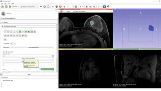 3D Slicer Tutorial  Segmentation Wizard [upl. by Maxantia]