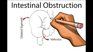 Intestinal Obstruction  Part 1 [upl. by Linnie236]