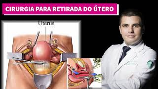 Histerectomia  A cirurgia para retirada do útero [upl. by Llet]