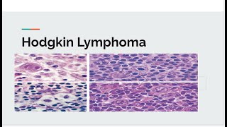 Hodgkin lymphoma [upl. by Carlisle]