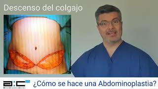 ¿Cómo se hace una Abdominoplastia [upl. by Karissa]