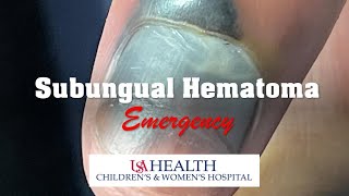 Subungual Hematoma Emergency and Trephination Procedure [upl. by Nester]