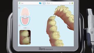 iTero® Scanner Tutorial Using the MultiBite Function [upl. by Baillie868]