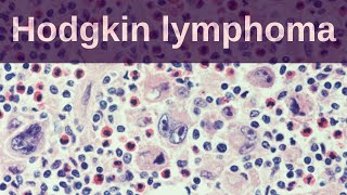 Hodgkin Lymphoma  Pathology mini tutorial [upl. by Cornish]