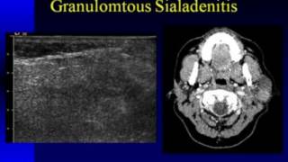 4 Steps to Treat Salivary Gland Swelling at Home [upl. by Dahcir934]