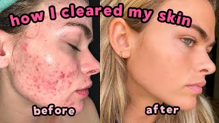 My Accutane Experience amp How I Cleared My Severe Acne  QampA with lots of pictures [upl. by Bradley]