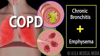 COPD  Chronic Obstructive Pulmonary Disease Animation [upl. by Parent]