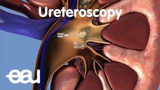 Removal of kidney stones URS [upl. by Marquet]