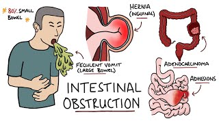 Bowel Obstruction and Ileus Ileus amp Small Bowel Obstruction – Radiology  Lecturio [upl. by Celene405]