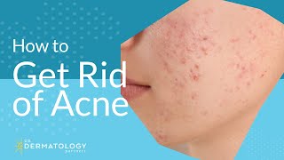 Acne Treatment  Explained by Dermatologist [upl. by Fischer62]