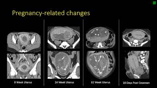 Gynecologic Radiology Anatomy [upl. by Nirehtak858]