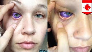 Eye tattoo gone wrong Models eyeball inking results in vision loss  TomoNews [upl. by Relyhs]