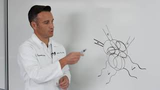 Cavernous hemangioma  Pathology Usmle step 1 [upl. by Eelahc]