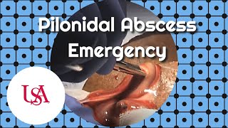 Pilonidal Abscess Emergency Incision amp Drainage [upl. by Phenice]