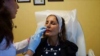 UNDER EYE BOTOX Experience amp Footage  BeforeAfter Cost Pain Bruising [upl. by Switzer]