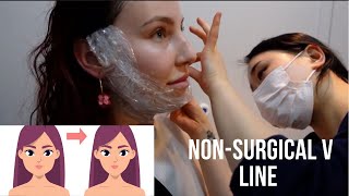 Botox VLine Injections  Seoul Guide Medical [upl. by Nyllek172]